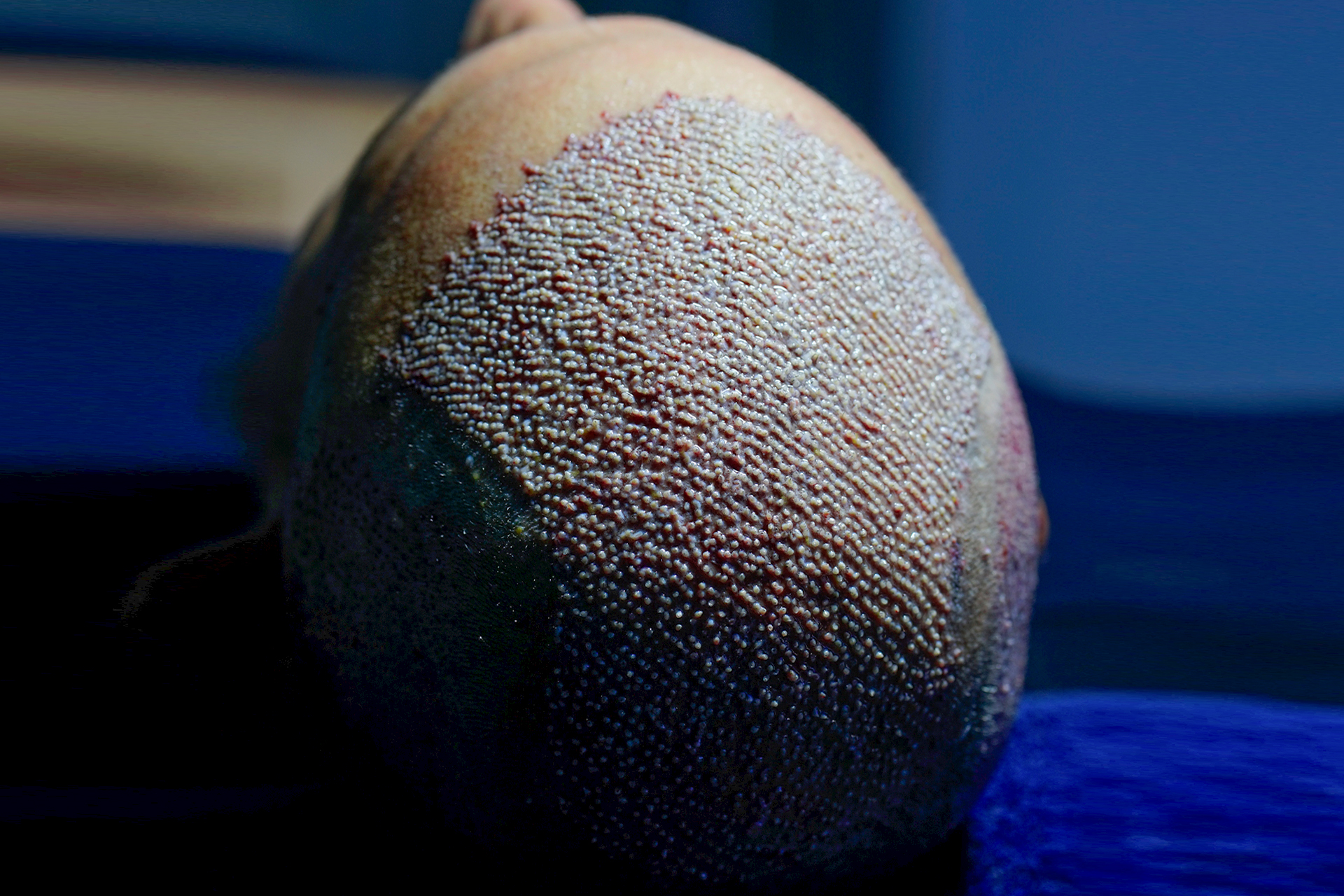 Kıbrıs Saç Ekimi | Cyprus Hair Transplant Center | Saç Ekim Merkezi. En Uygun ve Sağlıklı Kıbrıs Güzellik Merkezi. Kaş Ekimi ve Anti Aging. Bölgesel İncelme. Best Hair Transplant in Cyprus