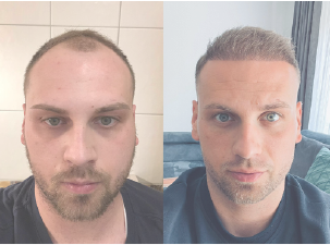 Kıbrıs Saç Ekimi | Cyprus Hair Transplant Center | Saç Ekim Merkezi. En Uygun ve Sağlıklı Kıbrıs Güzellik Merkezi. Kaş Ekimi ve Anti Aging. Bölgesel İncelme. Best Hair Transplant in Cyprus